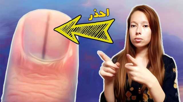 احذر من الخط الأسود تحت الظفر.. قد يعني مرضا قاتلا