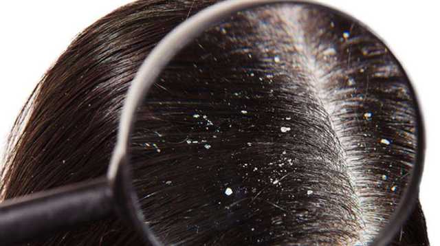 طُرق طبيعيةٌ للتخلص من قشرة الشعر المحرجة بشكل سريع وآمن