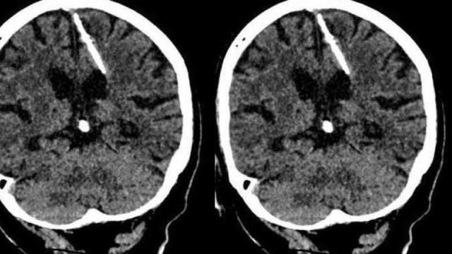 اكتشاف إبرة طولها 3 سم موجودة في دماغ امرأة روسية منذ 80 عاماً