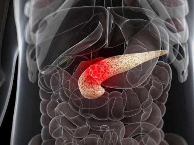 زيادة إصابة الشباب بسرطان البنكرياس دون ارتفاع الوفيات.. ما السر؟