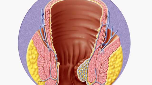 ‫6 عوامل ترفع خطر تضخم البواسير