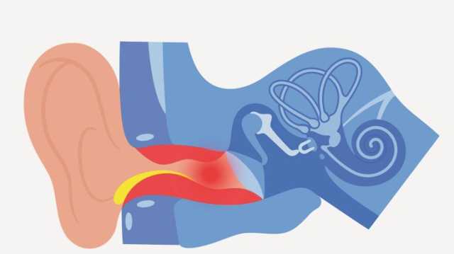 التهاب قناة الأذن.. الأسباب والأعراض