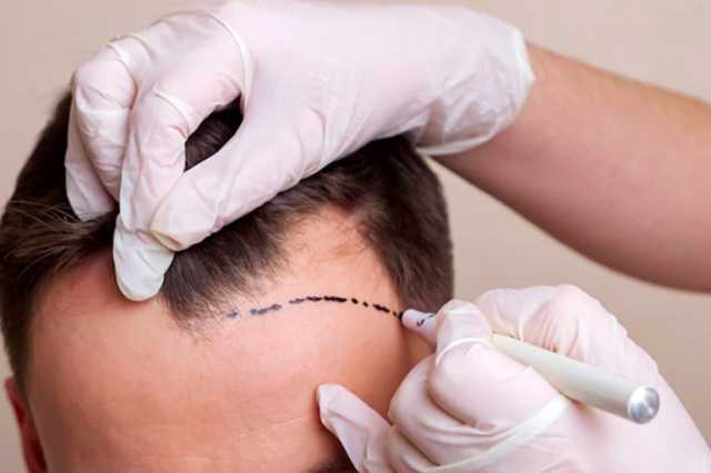 تركيا تواجه تحديات هيمنتها على زراعة الشعر مع انخفاض تكلفتها في أوروبا