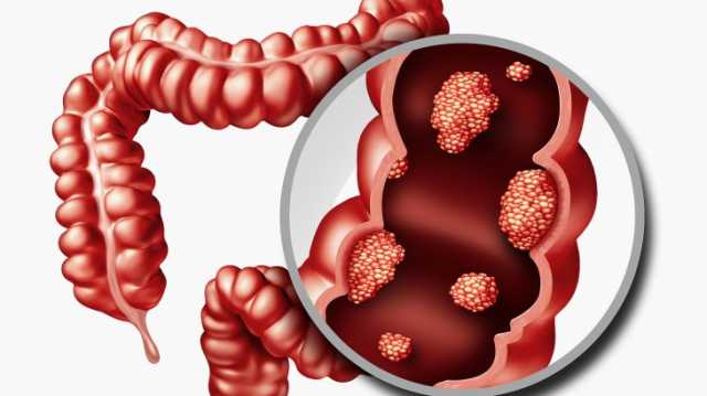 تغيرات طارئة قد تشير إلى سرطان القولون