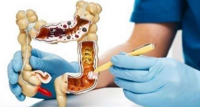 الأسباب الرئيسية لسرطان الأمعاء