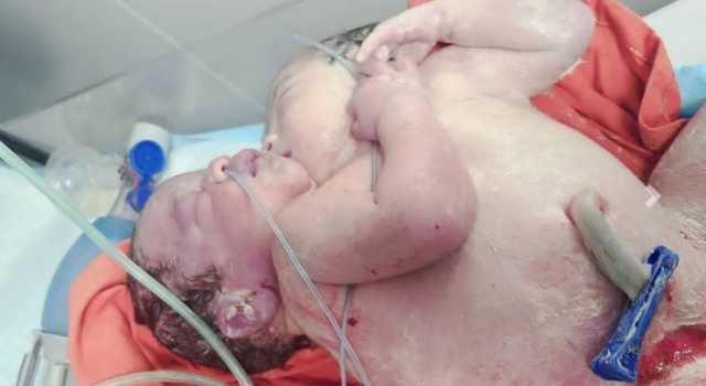 ولادة توأم سيامي في أحد مشافي صنعاء