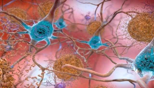 علماء يتتبعون كيفية موت خلايا الدماغ لدى مرضى ألزهايمر