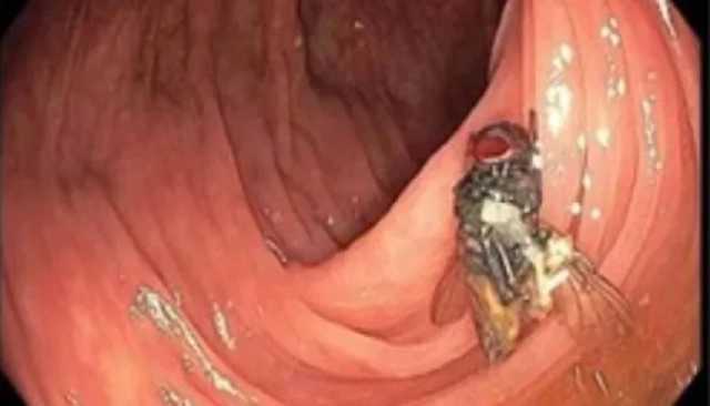 أطباء يعثرون على ذبابة حية تطن داخل أمعاء رجل