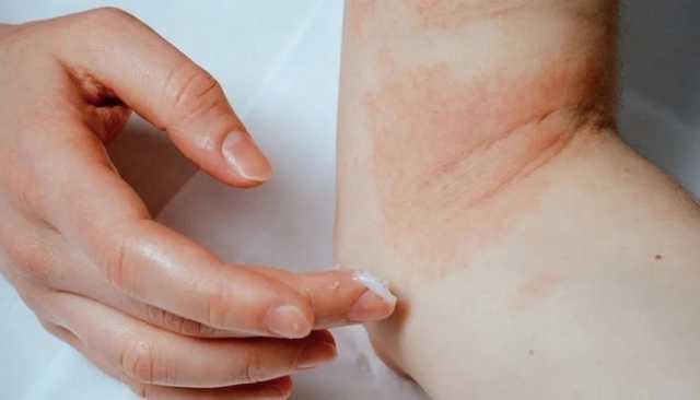 أنواع الطفح الجلدي الـ 5 الأكثر شيوعاً