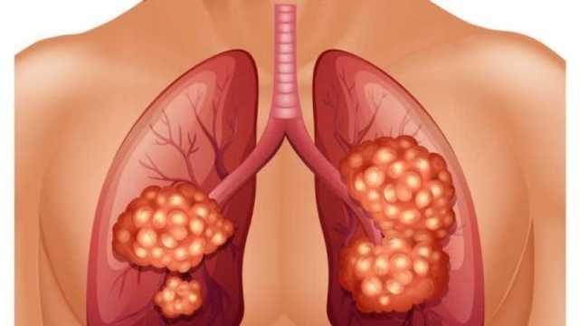 4 علامات غير شائعة تشير إلى الإصابة بسرطان الرئة.. لا تتجاهلها