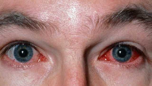 علامات تدل على الإصابة بفيروس العين الوردية المنتشر في باكستان.. اعرفها