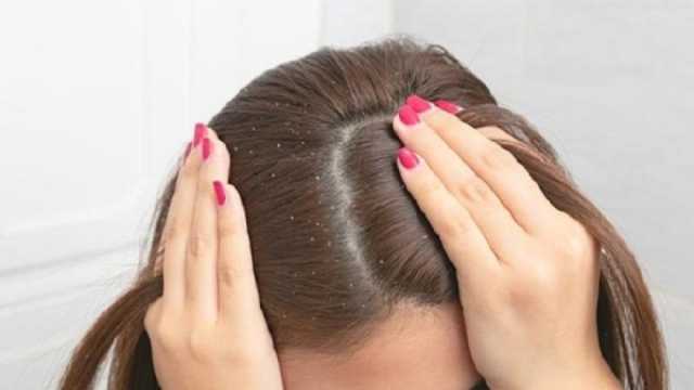 5 طرق منزلية للتخلص من قشرة الشعر نهائيا.. أبرزها وصفة زيت الزيتون