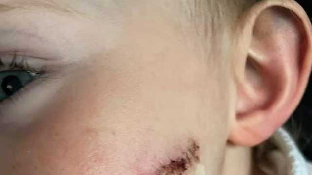 كدمة على الجلد تكشف إصابة طفلة بمتلازمة خطيرة.. ما القصة؟