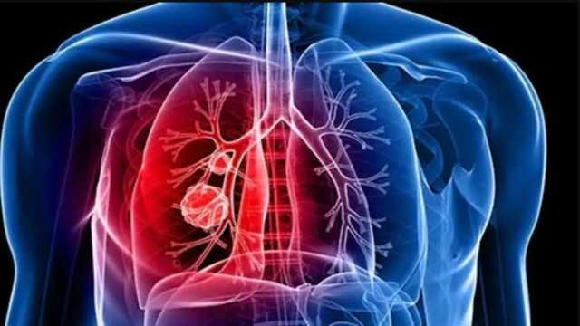 أعراض الإصابة بسرطان الرئة.. منها آلام في الصدر والمدخنون أول الضحايا