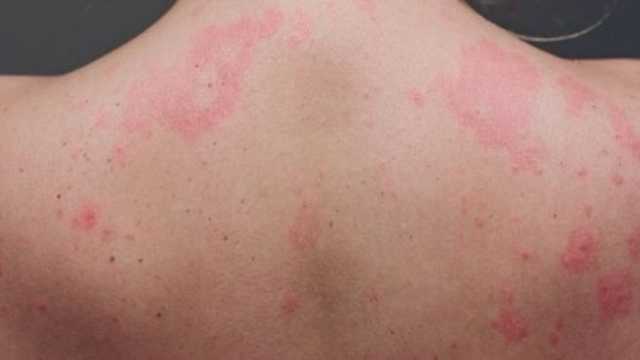 7 نصائح لتجنب الطفح الجلدي في فصل الصيف.. إليك أبرز أعراضه