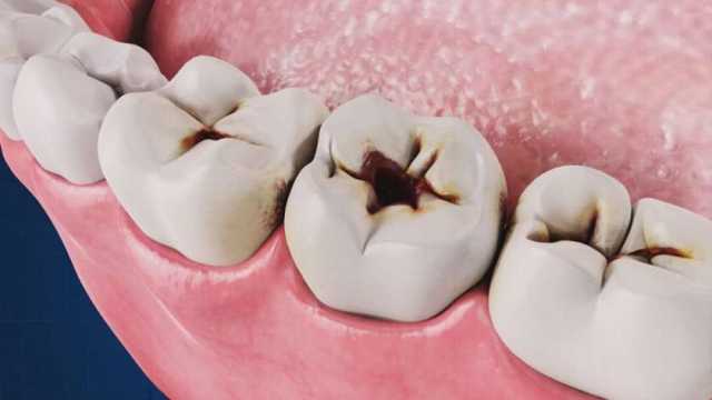 5 حيل طبيعية لعلاج تسوس الأسنان.. اضحك من غير كسوف