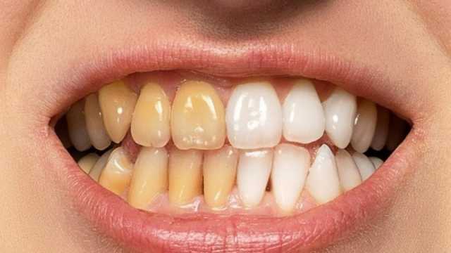 14 إجراء للحفاظ على الأسنان واللثة ومنع التسوس.. زيارة الطبيب كل ستة أشهر