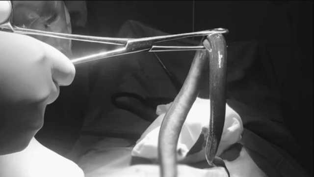 أطباء يكتشفون ثعبان بحر حيا داخل بطن مريض فيتنامي.. كيف وصل إلى الأمعاء؟