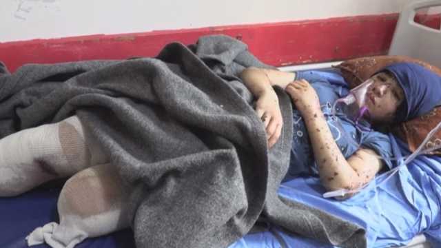 طفلة فلسطينية تبكي بعد بتر قدميها في قصف منزلها بغزة: «ازرعوا لي ساقي» (فيديو)