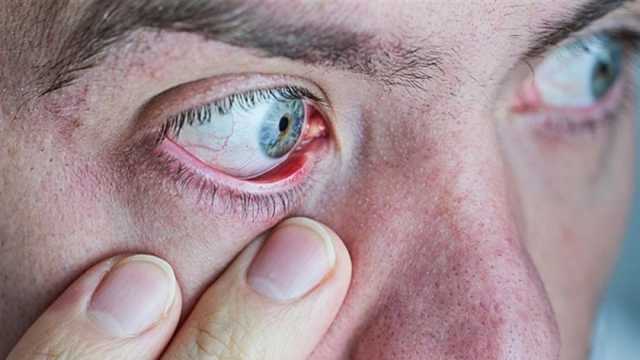 احذر تجاهلها.. 5 علامات تظهر على العين تٌخبرك بالإصابة بأمراض خطيرة