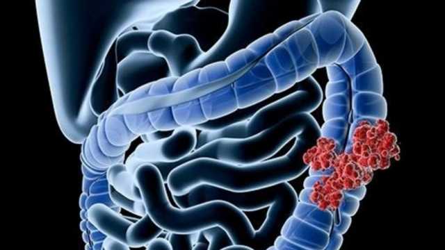 سبب مثير للقلق.. مفاجأة حول الإصابة بسرطان الأمعاء وجرثومة المعدة