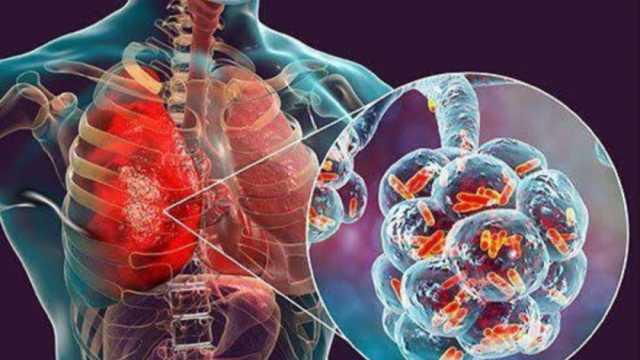 استشاري أمراض صدرية: عدوى الالتهاب الرئوي تكون باستنشاق الرذاذ