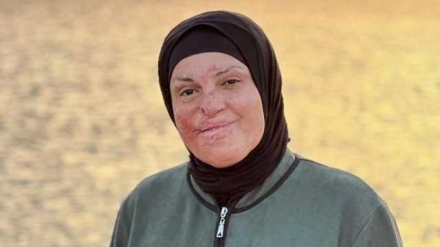 جميلة الوجه رغم الأحقاد.. رحلة علاج إسراء جعابيص بعد تحررها من سجون إسرائيل