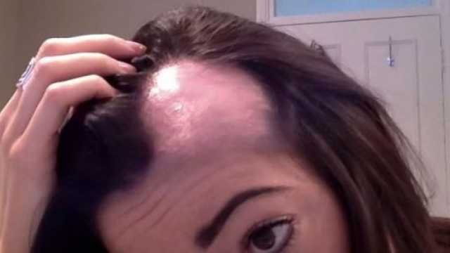 علماء يبتكرون علاجا فعالا لـ«مدمر بصيلات الشعر».. نتائج سريعة ودون ألم
