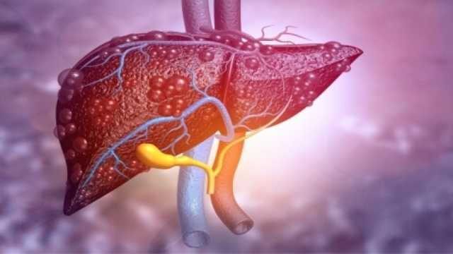 تراجع الحالات المتأخرة لمرضى سرطان الكبد بنسبة 14% في مصر.. ما الأسباب؟