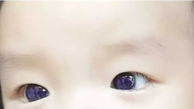 دواء مضاد لكورونا يغير لون عين طفل في دولة آسيوية.. ما القصة؟