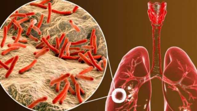 في اليوم العالمي للسل 2024.. ما هي طرق الوقاية وأشهر أعراضه؟