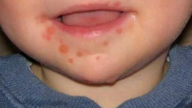 فيروس متلازمة الفم واليد والقدم يصيب الأطفال أقل من 5 سنوات.. ما الأعراض؟