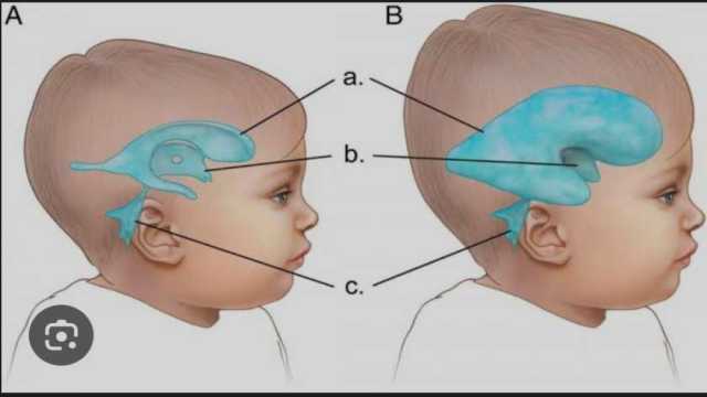 قاتل صامت يخطف حياة الأطفال.. احذر أعراض «الاستسقاء الدماغي»