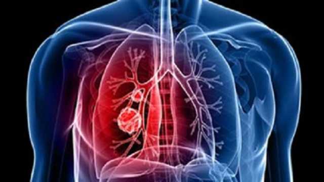 زيادة غير مسبوقة في الإصابة بالأمراض التنفسية عالميا.. و«الصحة العالمية» تكشف طرق الوقاية
