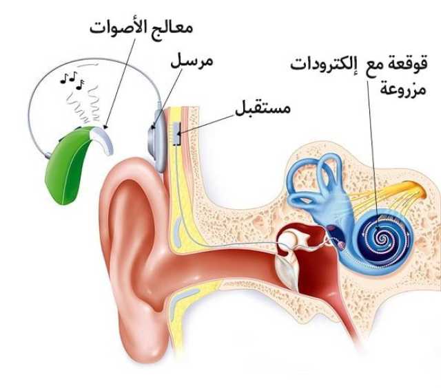 بنسبة نجاح تصل لـ100 %.. “التجمعات الصحية” تُجري أكثر من 500 عملية زراعة قوقعة سنويًا