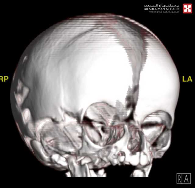 مستشفى الدكتور سليمان الحبيب بالخبر يُعيد بناء عظام الجمجمة بالمنظار لرضيعه تعاني من تشوه خلقي