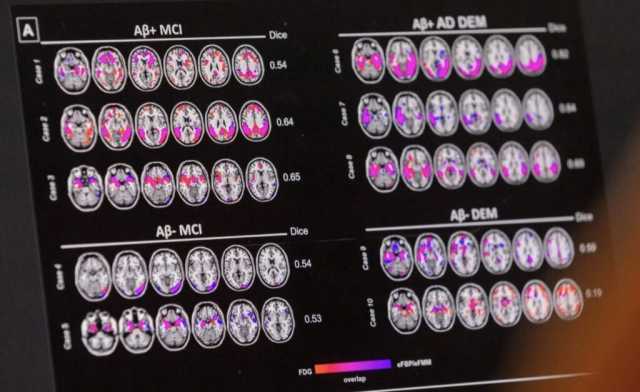 اكتشاف الإصابة بألزهايمر يتاح قريباً بفحص دم