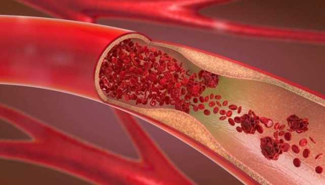 هل يمكن علاج تصلب الشرايين؟