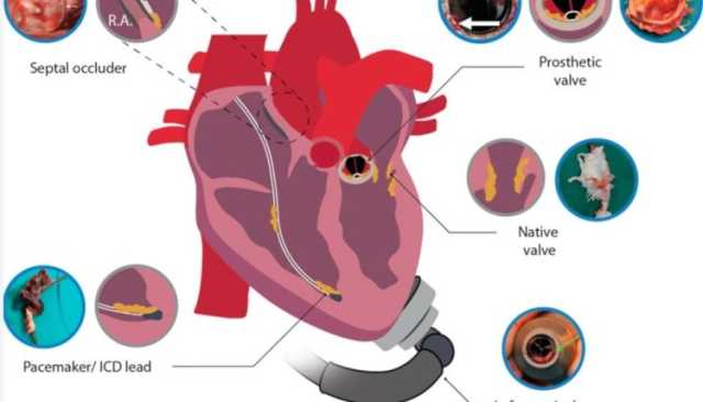 تطوير صمّام قلب جديد لتفادي مشكلات عمليات استبدال الصمّامات