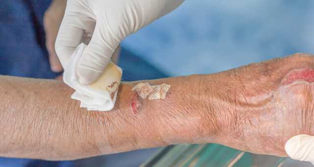 طفيليات مسببة لآفات جلدية “مخيفة” قد تحمل سر كيفية منع الألم