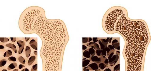 3 عادات صحية تساعد على الوقاية من هشاشة العظام