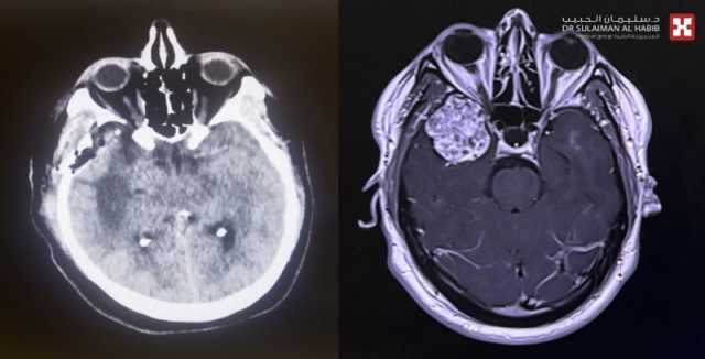 مستشفى الدكتور سليمان الحبيب بالخبر يستأصل ورماً دماغياً سبب فقدان الوعي وتشنجات حادة لخمسيني