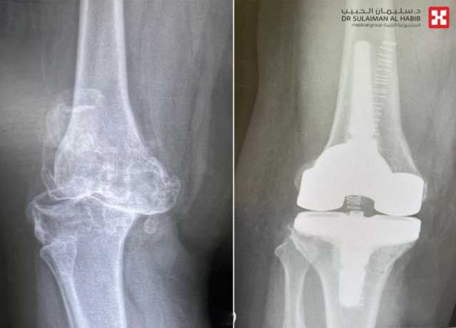 مستشفى الدكتور سليمان الحبيب بالخبر يعيد الحركة لـسبعينية بعملية استبدال ركبة بالروبوت الجراحي