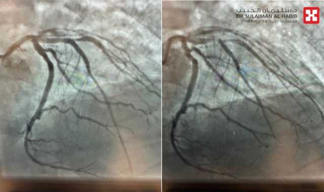 مستشفى الدكتور سليمان الحبيب بالخبر ينقذ 'خمسيني' مصاب بجلطة قلبية حادة بالشريان التاجي