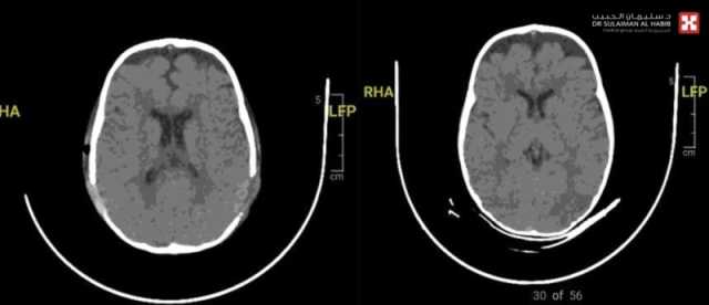 مستشفى الدكتور سليمان الحبيب بالخبر يُعيد بناء عظام الجمجمة لرضيع يعاني من تشوه خلقي نادر