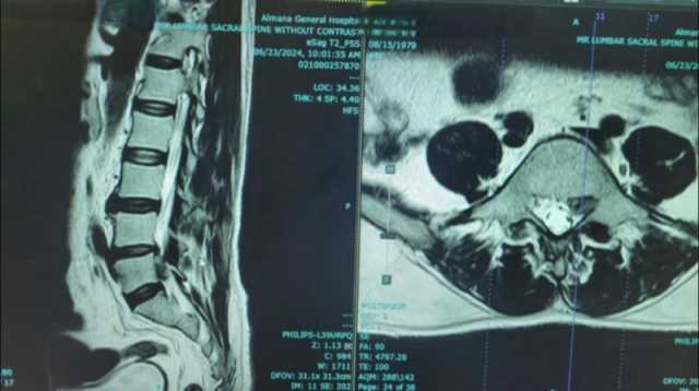 نجاح جراحة العمود الفقري بالمنظار في مستشفيات المانع