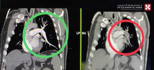 مستشفى الدكتور سليمان الحبيب بالخبر ينقذ 'أربعيني' عانى من جلطة رئوية مزدوجة وفشل بالقلب خلال '60' دقيقة
