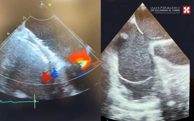 مستشفى الدكتور سليمان الحبيب بالخبر ينجح في علاج سبعينية من ثقبين في القلب خلال 15 دقيقة