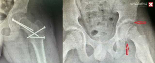 مستشفى الدكتور سليمان الحبيب بالخبر ينجح بإعادة قدرة المشي لطفل يعاني من انزلاق غضروفي نادر بالورك