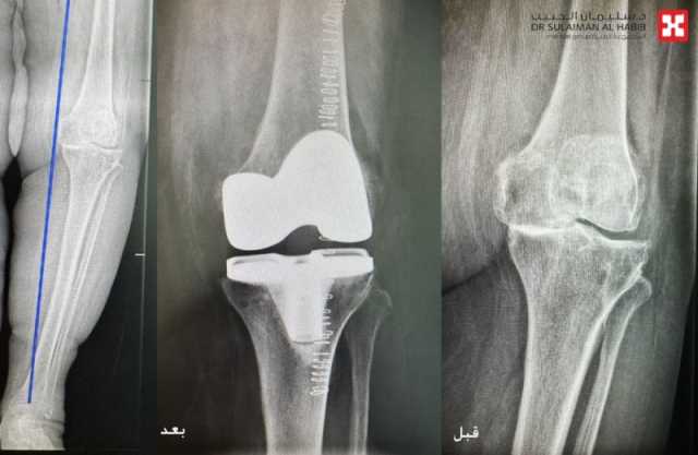 مستشفى الدكتور سليمان الحبيب بالخبر يُجري عملية دقيقة بالروبوت الجراحي لإعادة قدرة المشي لمراجعة 'تسعينية'